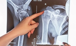 Рентгенография плечевого сустава( 2 проекции)