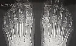 Рентгенография плюсны и фаланг пальцев стопы ( 2 проекции)